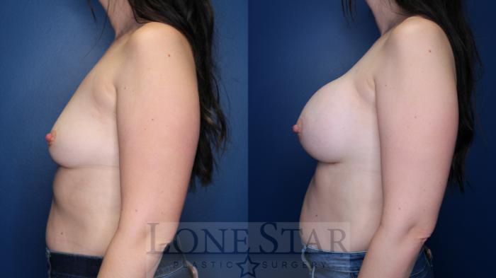Before & After Breast Augmentation Case 155 Left Side View in Frisco, TX