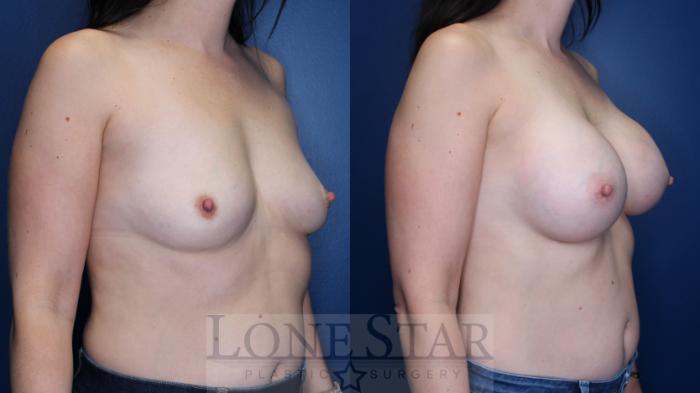 Before & After Breast Augmentation Case 155 Right Oblique View in Frisco, TX