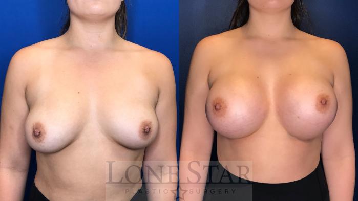 Before & After Breast Augmentation Case 157 Front View in Frisco, TX