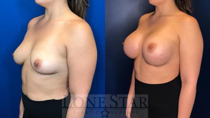 Before & After Breast Augmentation Case 157 Left Oblique View in Frisco, TX