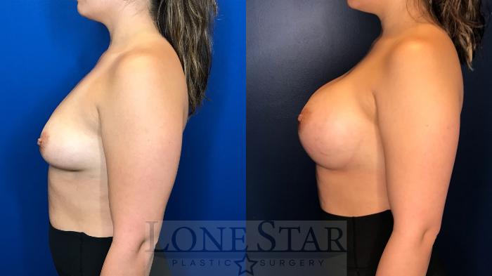 Before & After Breast Augmentation Case 157 Left Side View in Frisco, TX