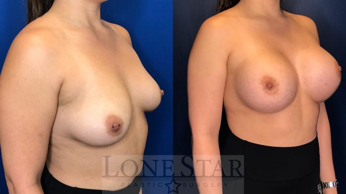 Before & After Breast Augmentation Case 157 Right Oblique View in Frisco, TX