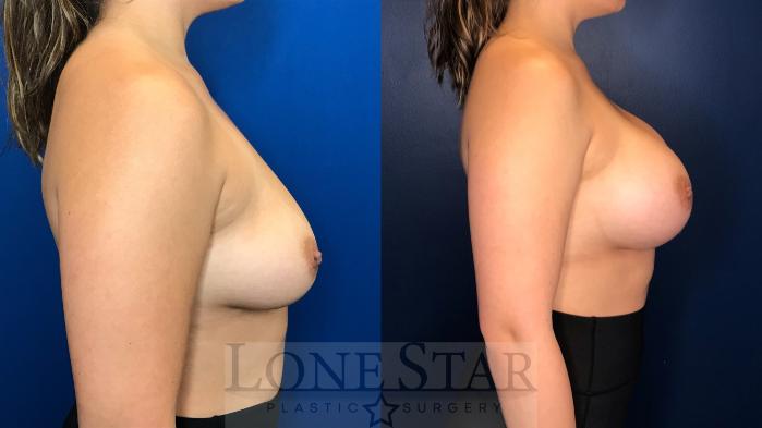 Before & After Breast Augmentation Case 157 Right Side View in Frisco, TX