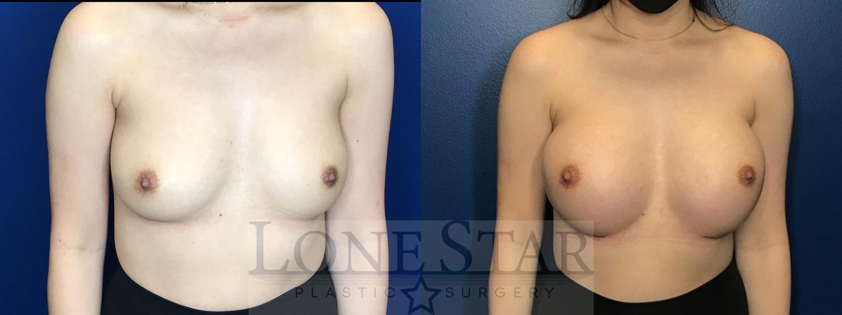 Before & After Breast Augmentation Case 159 Front View in Frisco, TX