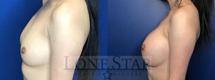 Before & After Breast Augmentation Case 159 Left Side View in Frisco, TX