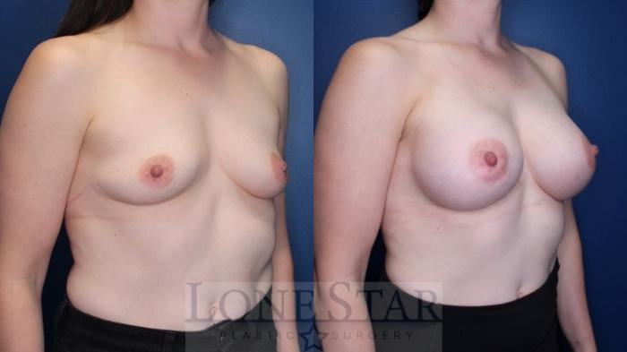 Before & After Breast Augmentation Case 168 Right Oblique View in Frisco, TX