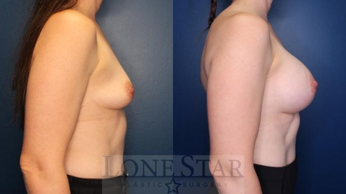 Before & After Breast Augmentation Case 168 Right Side View in Frisco, TX