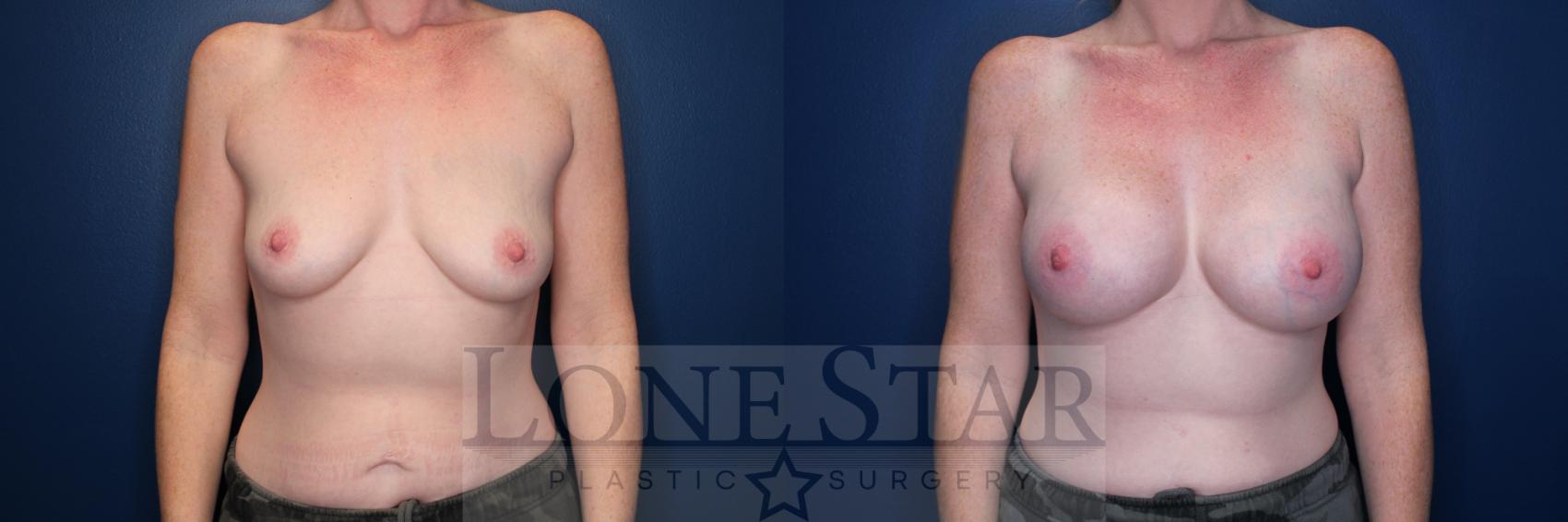 Before & After Breast Augmentation Case 176 Front View in Frisco, TX