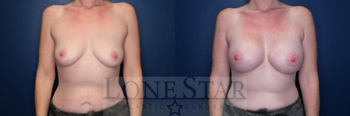 Before & After Breast Augmentation Case 176 Front View in Frisco, TX