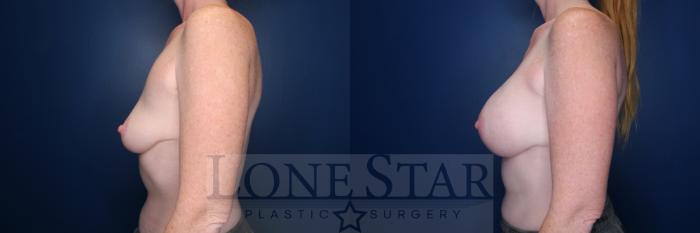 Before & After Breast Augmentation Case 176 Left Side View in Frisco, TX