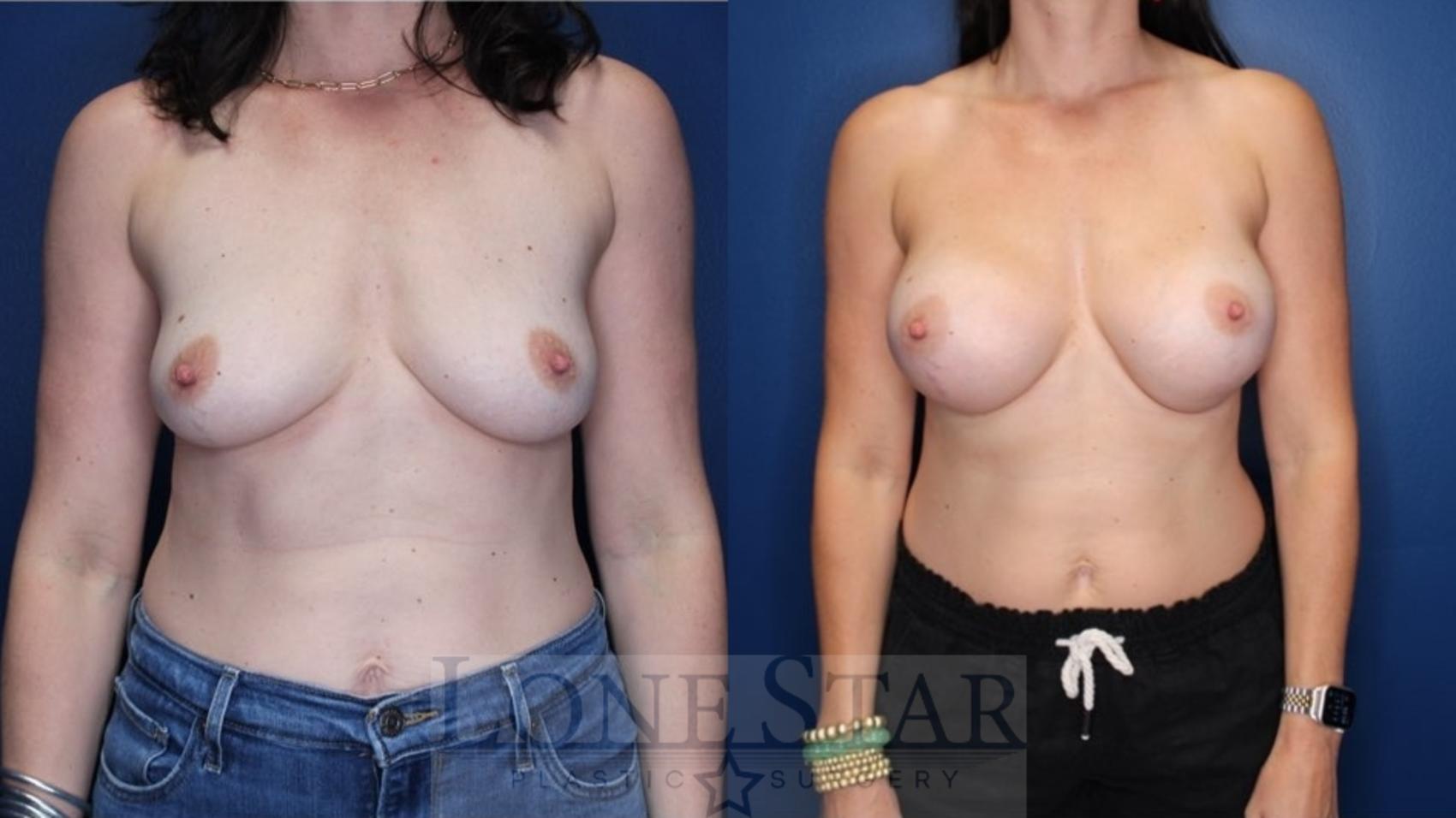 Before & After Breast Augmentation Case 177 Front View in Frisco, TX