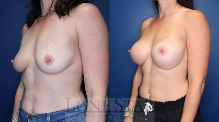 Before & After Breast Augmentation Case 177 Left Oblique View in Frisco, TX