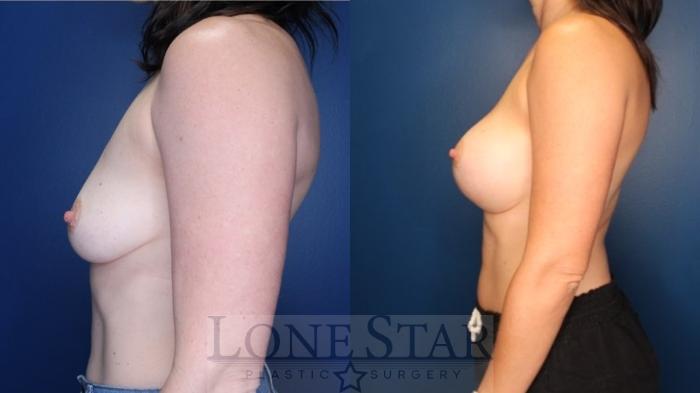Before & After Breast Augmentation Case 177 Left Side View in Frisco, TX