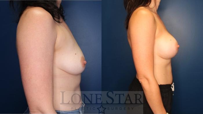 Before & After Breast Augmentation Case 177 Right Side View in Frisco, TX