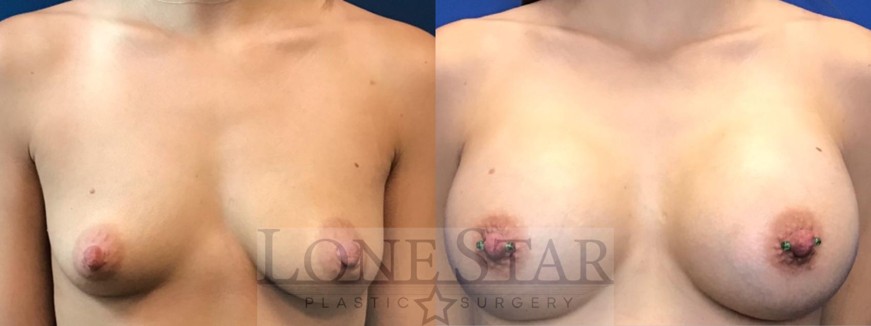Before & After Breast Augmentation Case 18 View #1 View in Frisco, TX