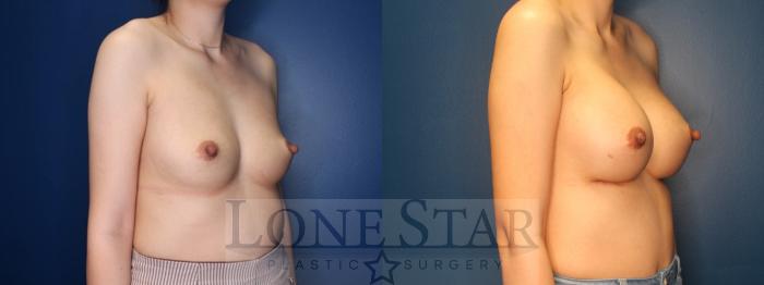 Before & After Breast Augmentation Case 186 Right Oblique View in Frisco, TX