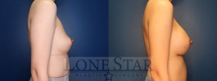 Before & After Breast Augmentation Case 186 Right Side View in Frisco, TX