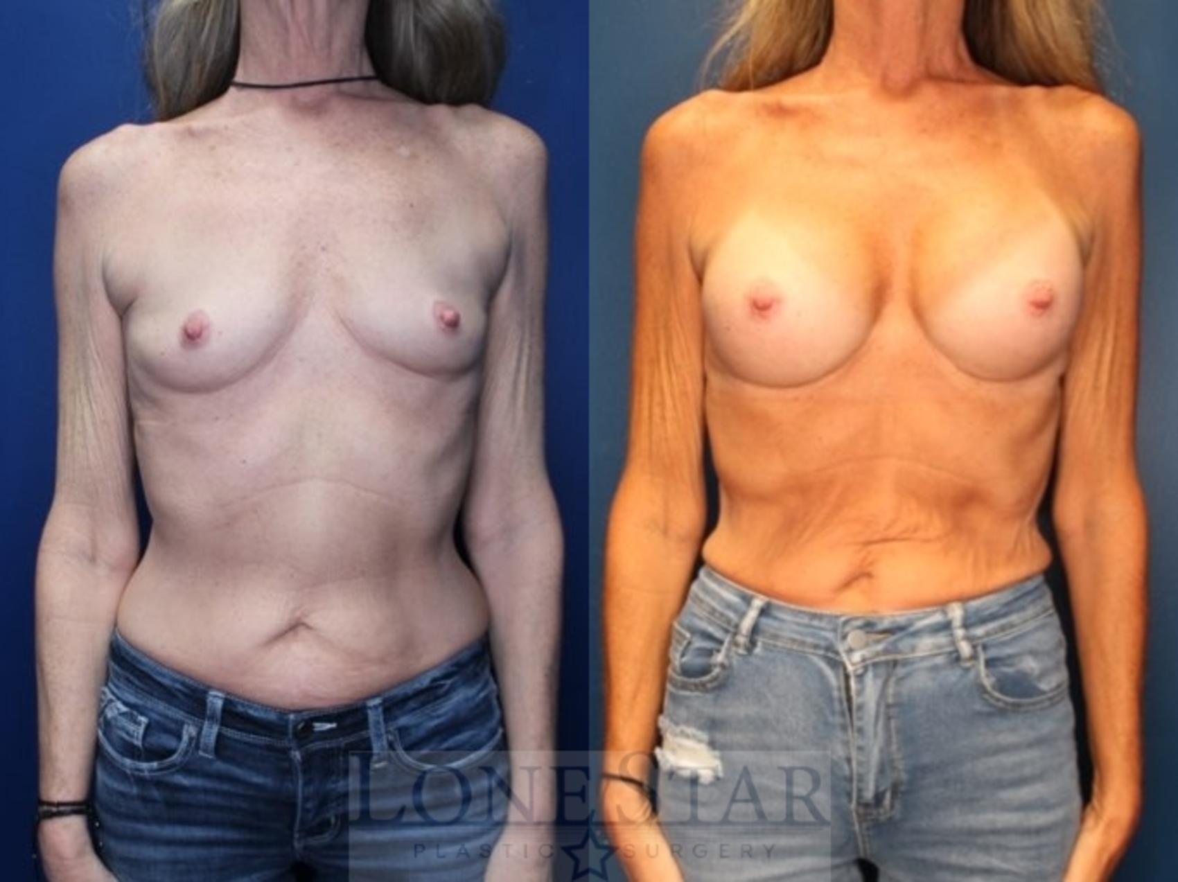 Before & After Breast Augmentation Case 187 Front View in Frisco, TX
