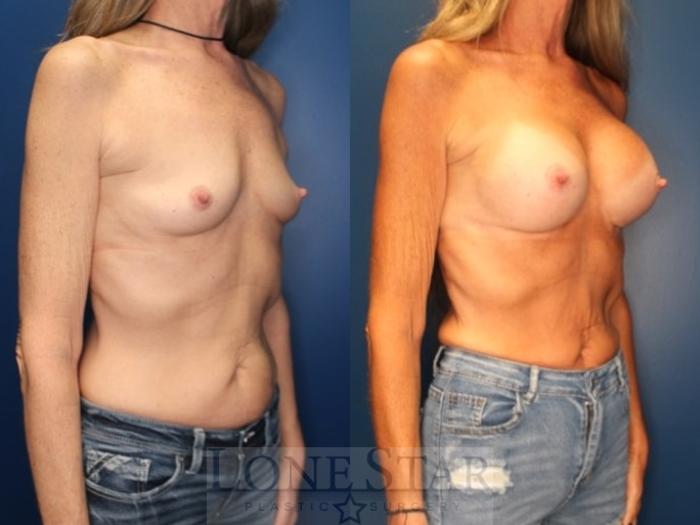 Before & After Breast Augmentation Case 187 Right Oblique View in Frisco, TX