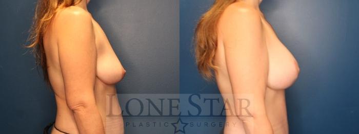 Before & After Breast Augmentation Case 188 Right Side View in Frisco, TX