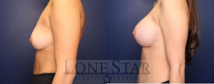 Before & After Breast Augmentation Case 193 Left Side View in Frisco, TX