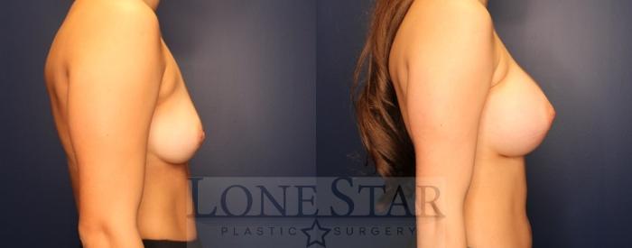 Before & After Breast Augmentation Case 193 Right Side View in Frisco, TX