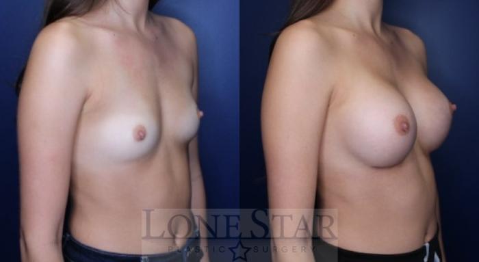 Before & After Breast Augmentation Case 222 Right Oblique View in Frisco, TX