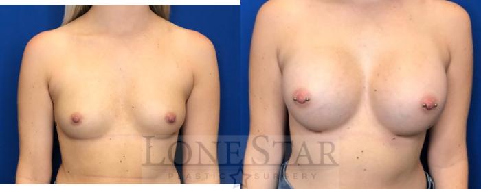 Before & After Breast Augmentation Case 40 View #1 View in Frisco, TX