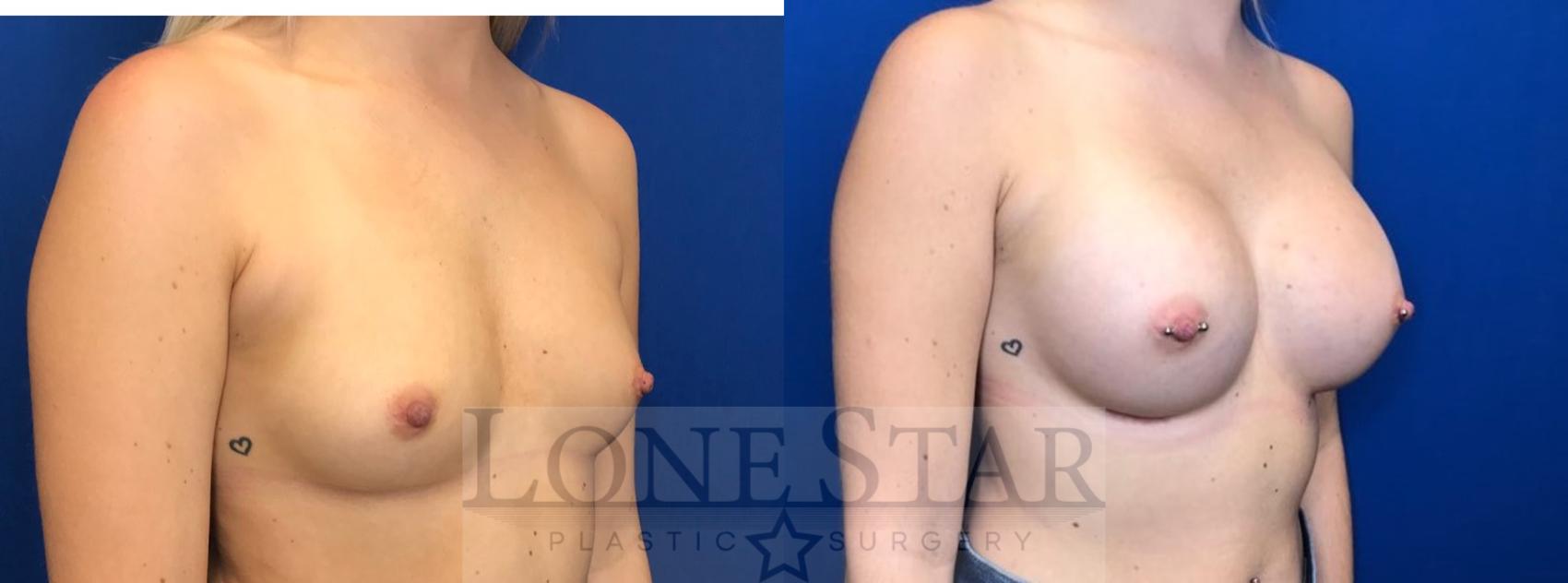 Before & After Breast Augmentation Case 40 View #2 View in Frisco, TX