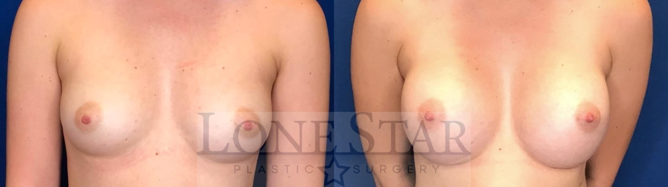 Before & After Breast Augmentation Case 48 Front View in Frisco, TX