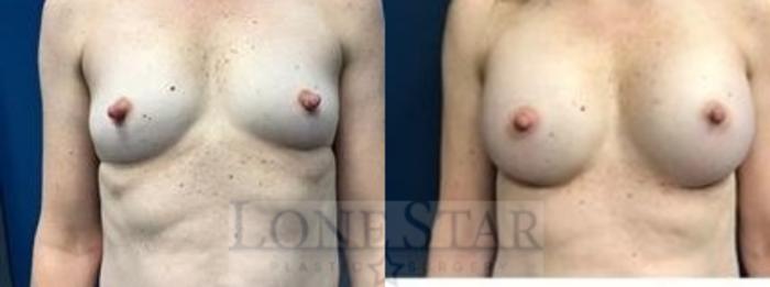 Before & After Breast Augmentation Case 5 View #1 View in Frisco, TX