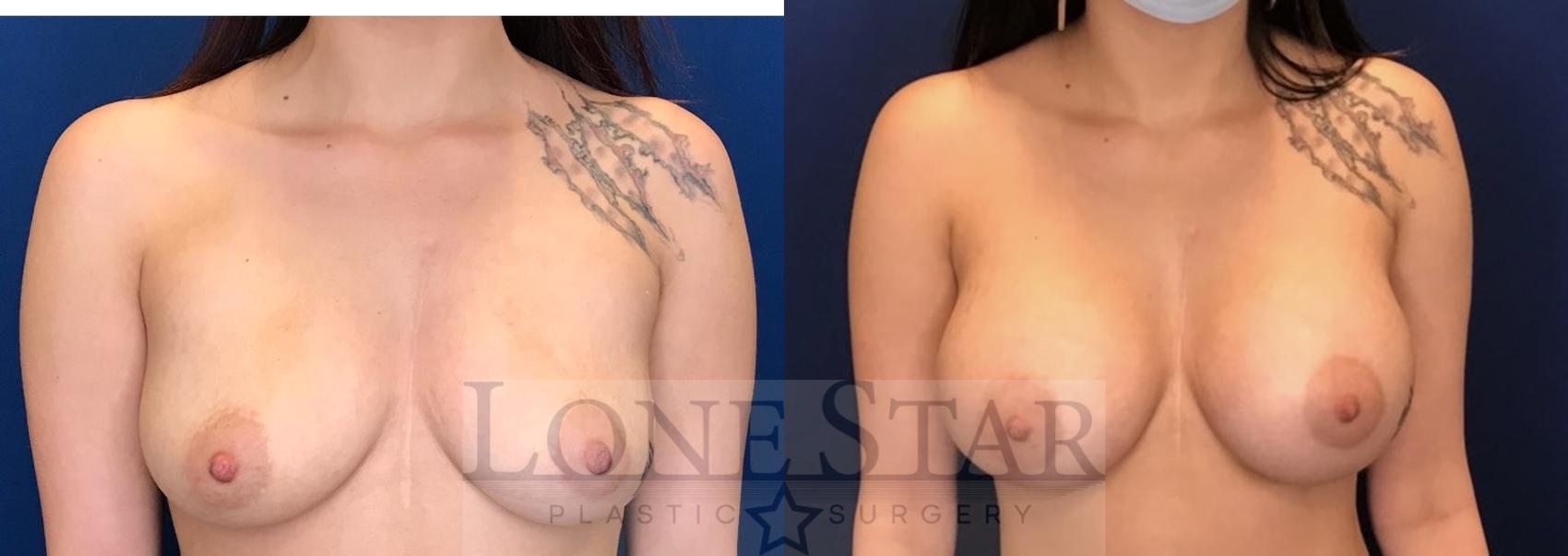 Before & After Breast Augmentation Case 50 Front View in Frisco, TX