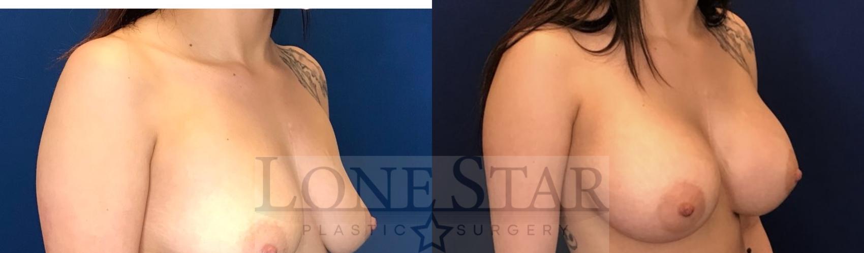 Before & After Breast Augmentation Case 50 Left Oblique View in Frisco, TX