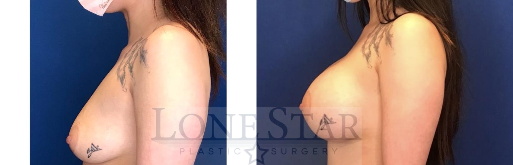 Before & After Breast Augmentation Case 50 Left Side View in Frisco, TX