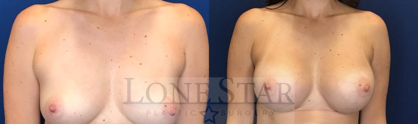 Before & After Breast Augmentation Case 51 Front View in Frisco, TX