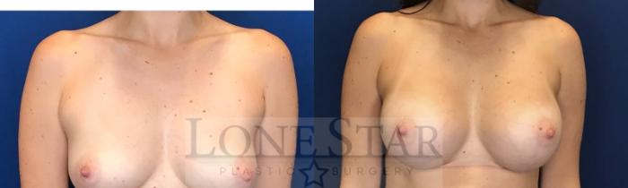 Before & After Breast Augmentation Case 51 Front View in Frisco, TX