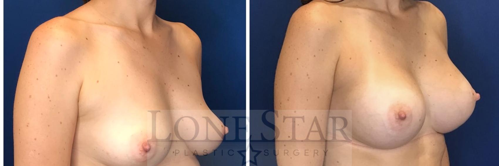 Before & After Breast Augmentation Case 51 Right Oblique View in Frisco, TX