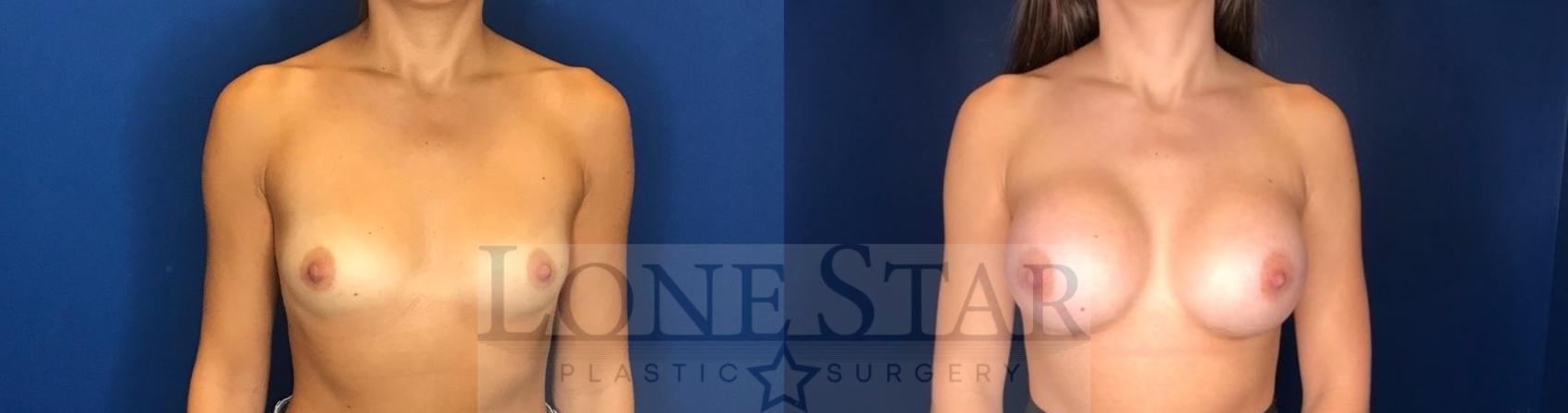 Before & After Breast Augmentation Case 58 Front View in Frisco, TX