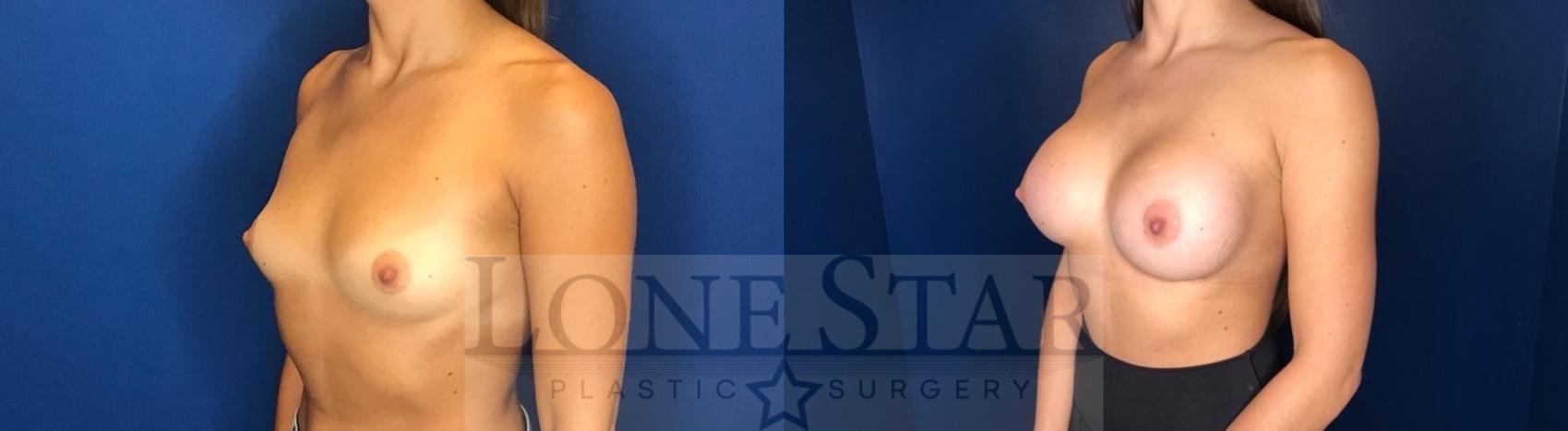 Before & After Breast Augmentation Case 58 Left Oblique View in Frisco, TX