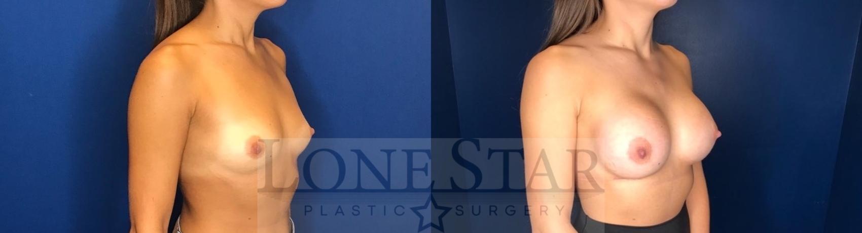 Before & After Breast Augmentation Case 58 Right Oblique View in Frisco, TX