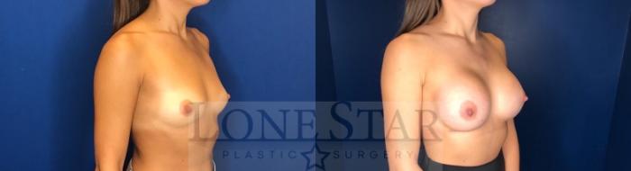 Before & After Breast Augmentation Case 58 Right Oblique View in Frisco, TX