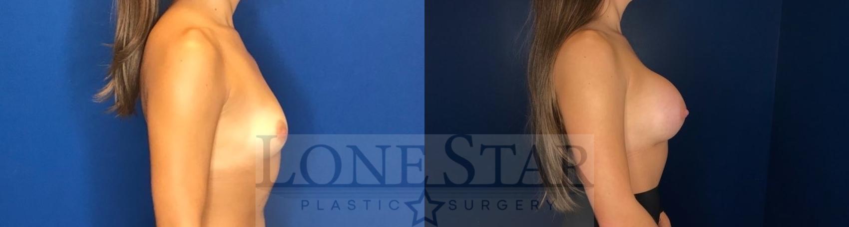 Before & After Breast Augmentation Case 58 Right Side View in Frisco, TX