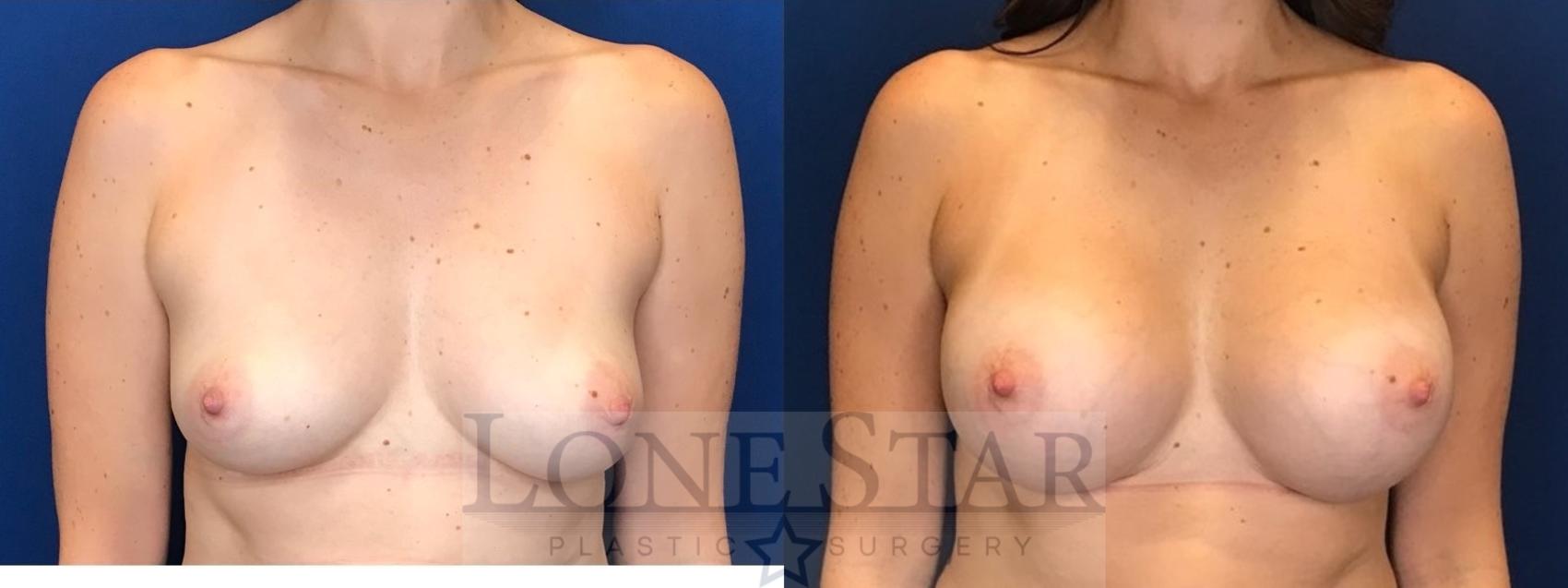 Before & After Breast Augmentation Case 64 Front View in Frisco, TX