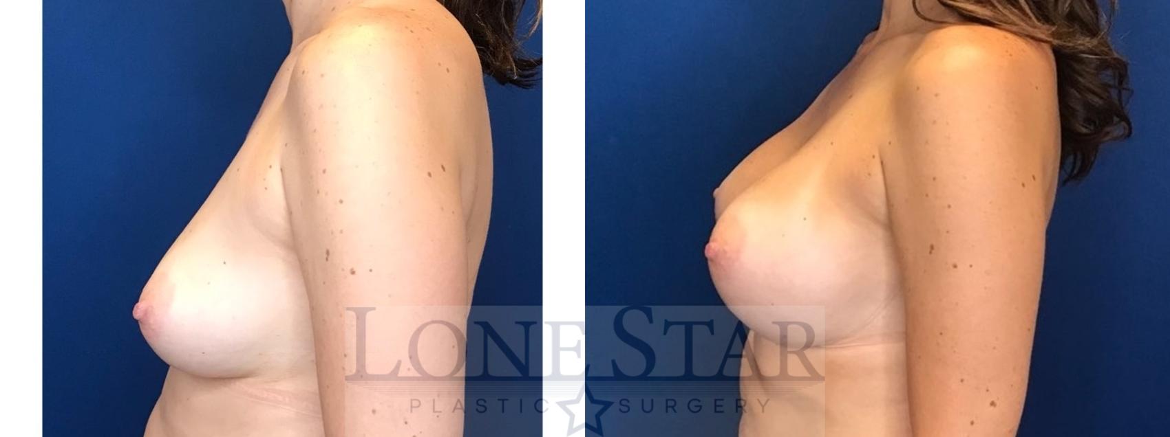 Before & After Breast Augmentation Case 64 Left Side View in Frisco, TX