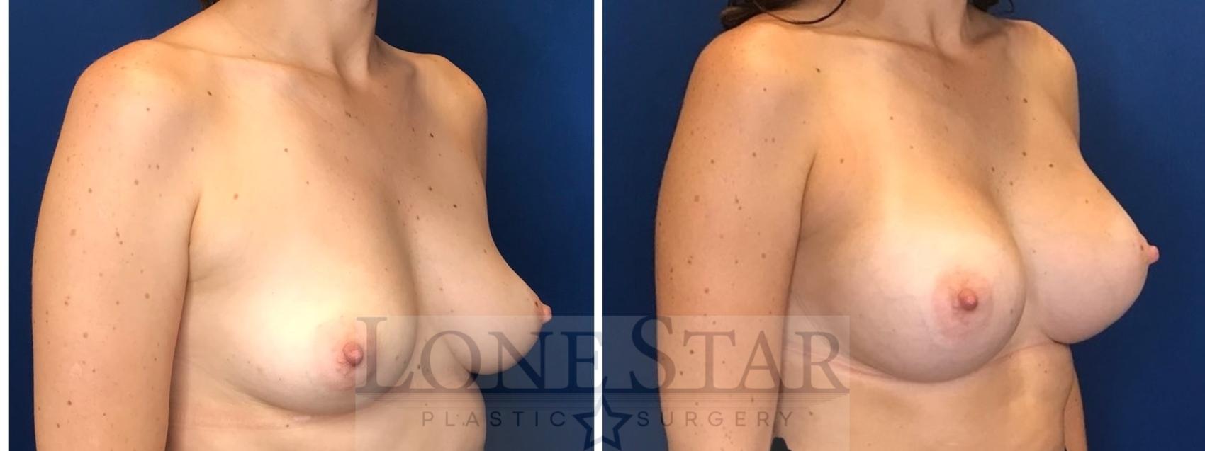 Before & After Breast Augmentation Case 64 Right Oblique View in Frisco, TX