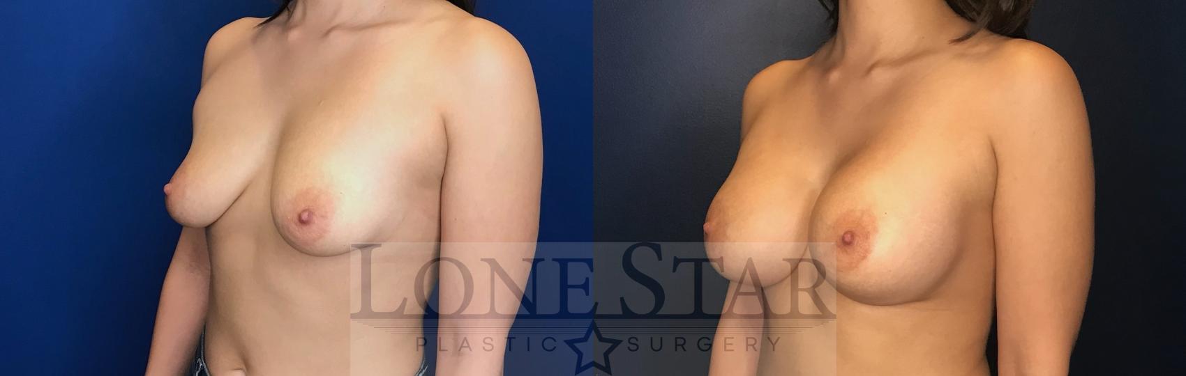 Before & After Breast Augmentation Case 65 Left Oblique View in Frisco, TX