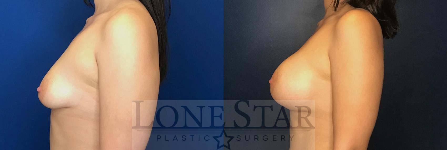 Before & After Breast Augmentation Case 65 Left Side View in Frisco, TX
