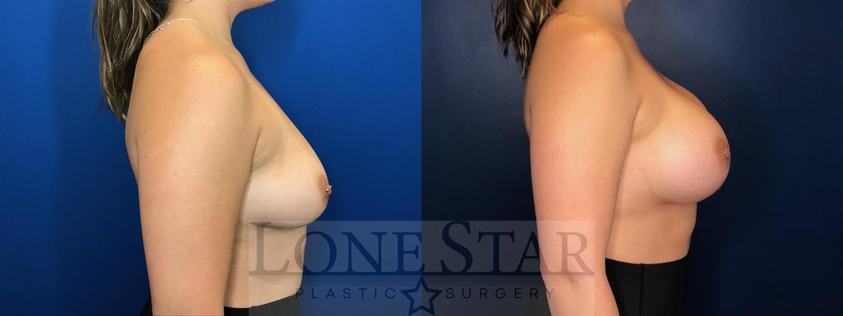 Before & After Breast Augmentation Case 67 Right Side View in Frisco, TX