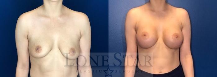 Before & After Breast Augmentation Case 68 Front View in Frisco, TX