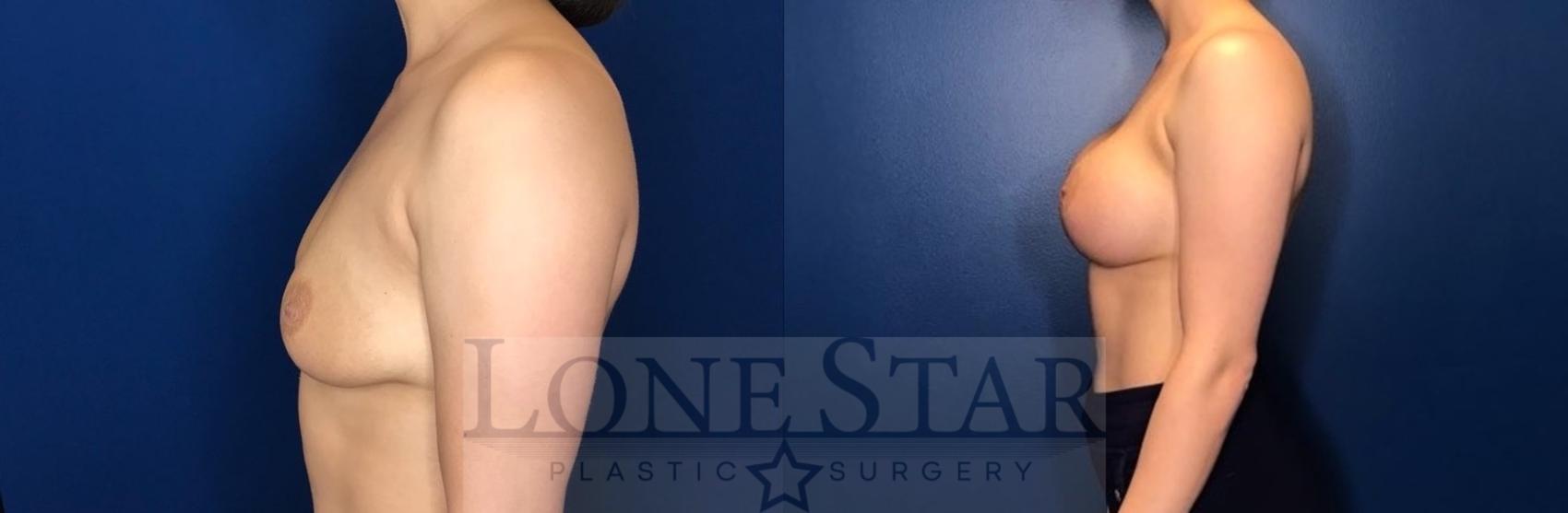Before & After Breast Augmentation Case 68 Left Side View in Frisco, TX